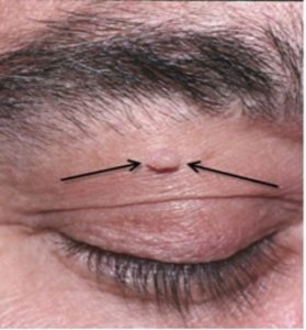 Skin Tags, Lump or Bump Warrant a Biopsy?