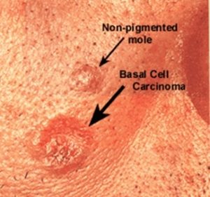 Eyelid Reconstruction for Cancer
